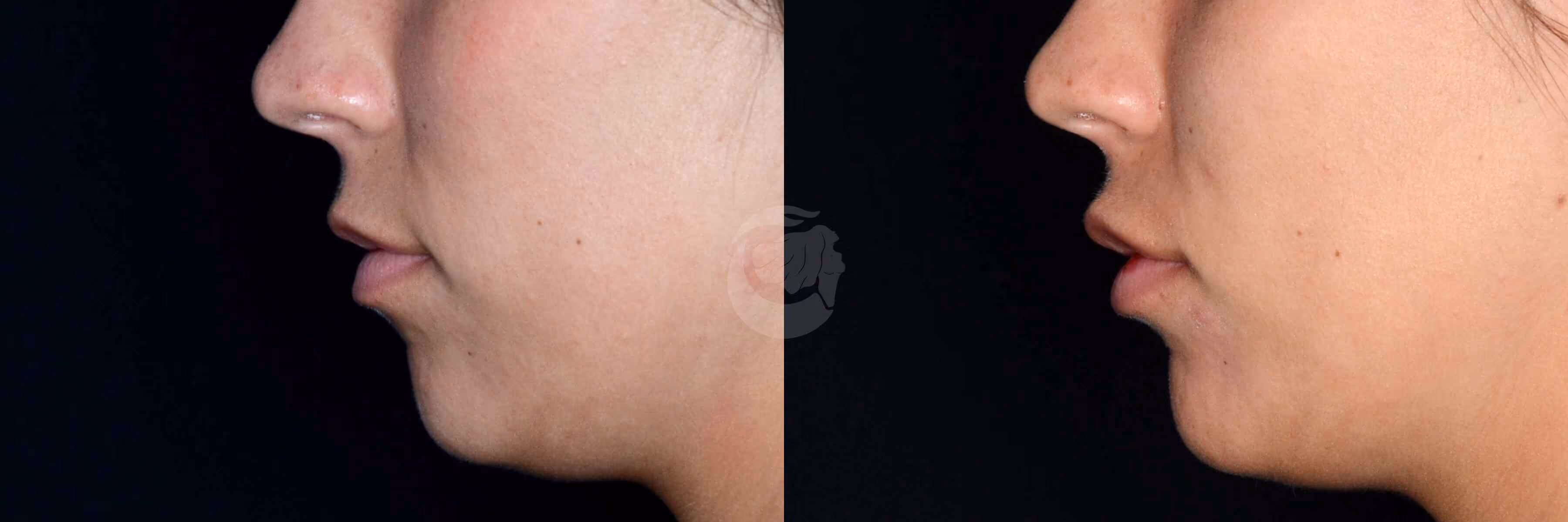 Before And After Patient Image