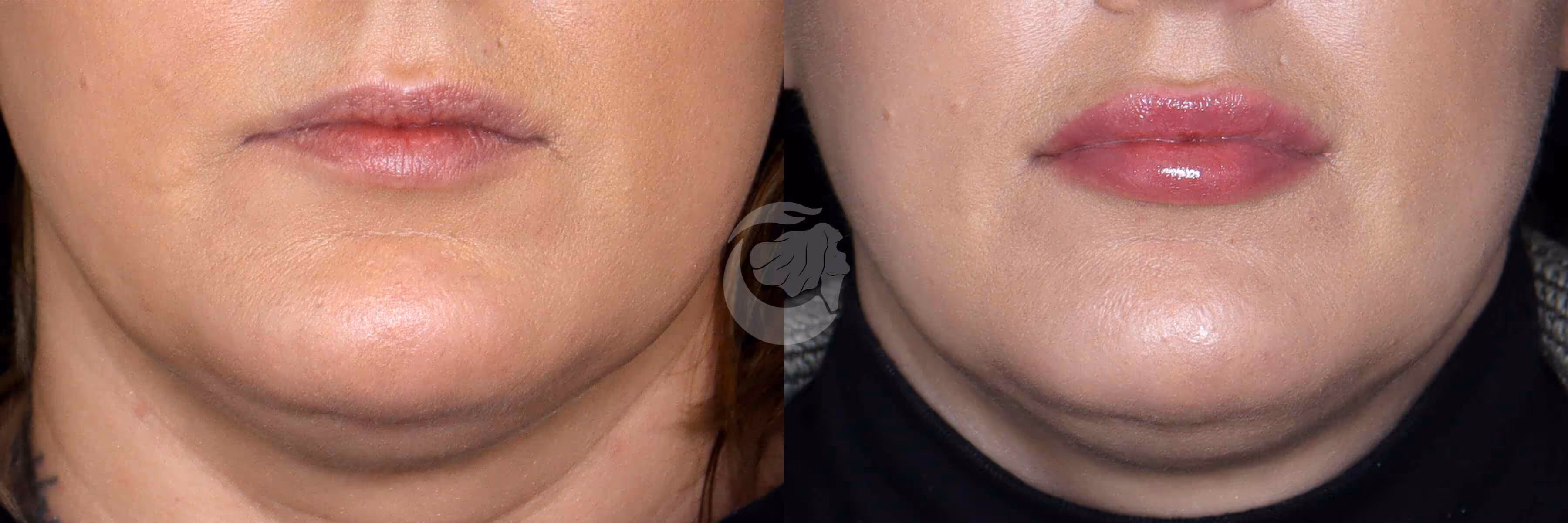 Before And After Patient Image