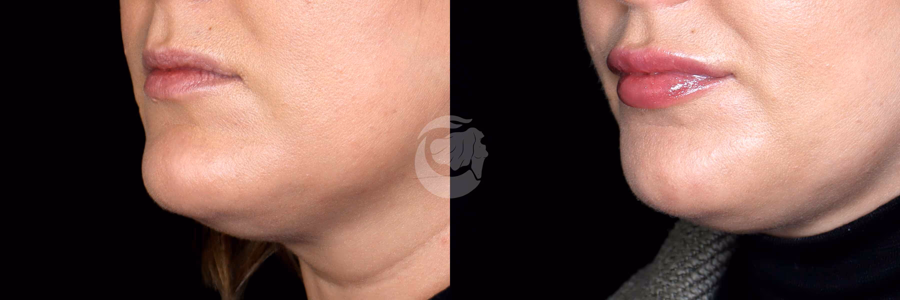 Before And After Patient Image