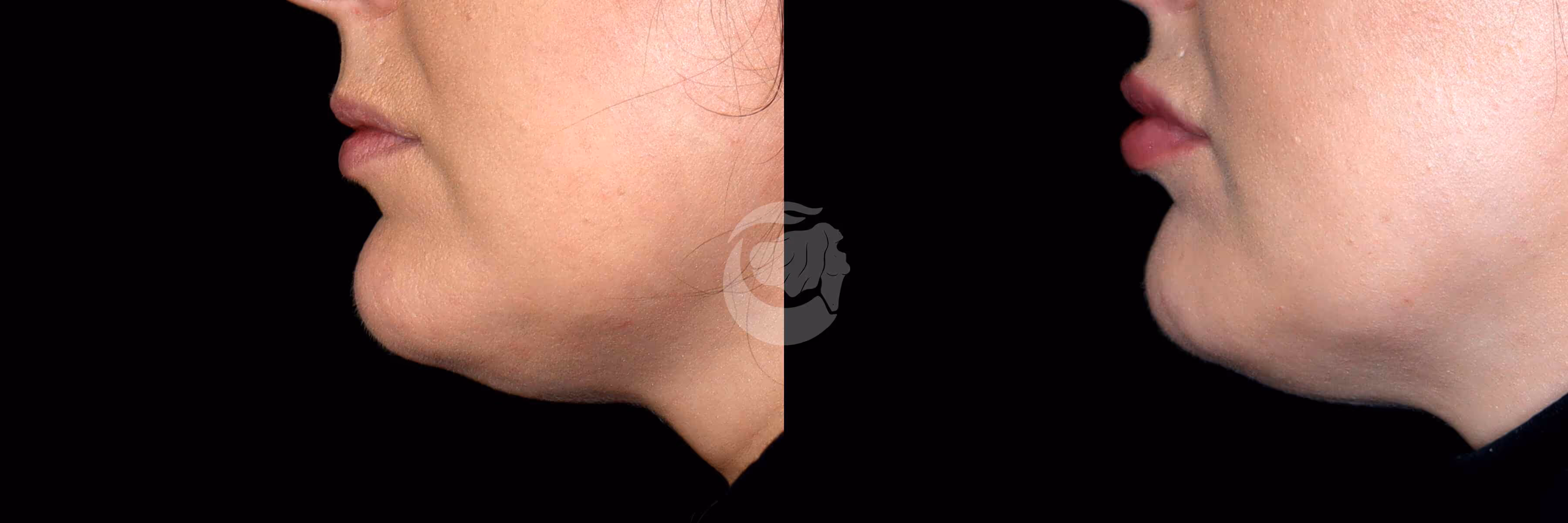 Before And After Patient Image