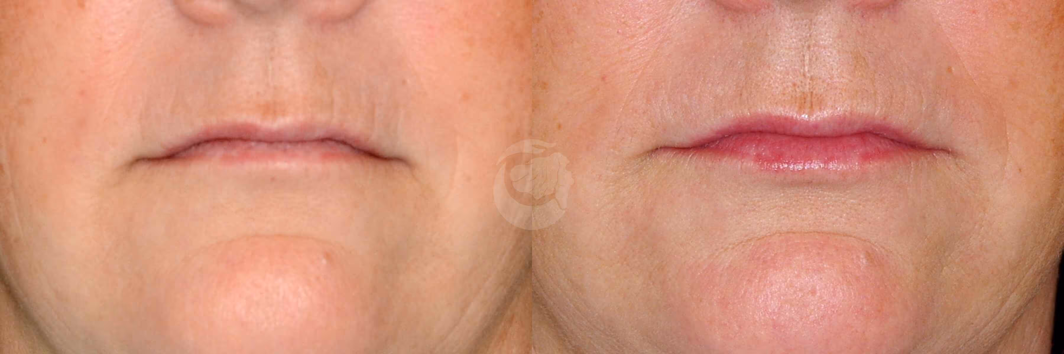 Before And After Patient Image