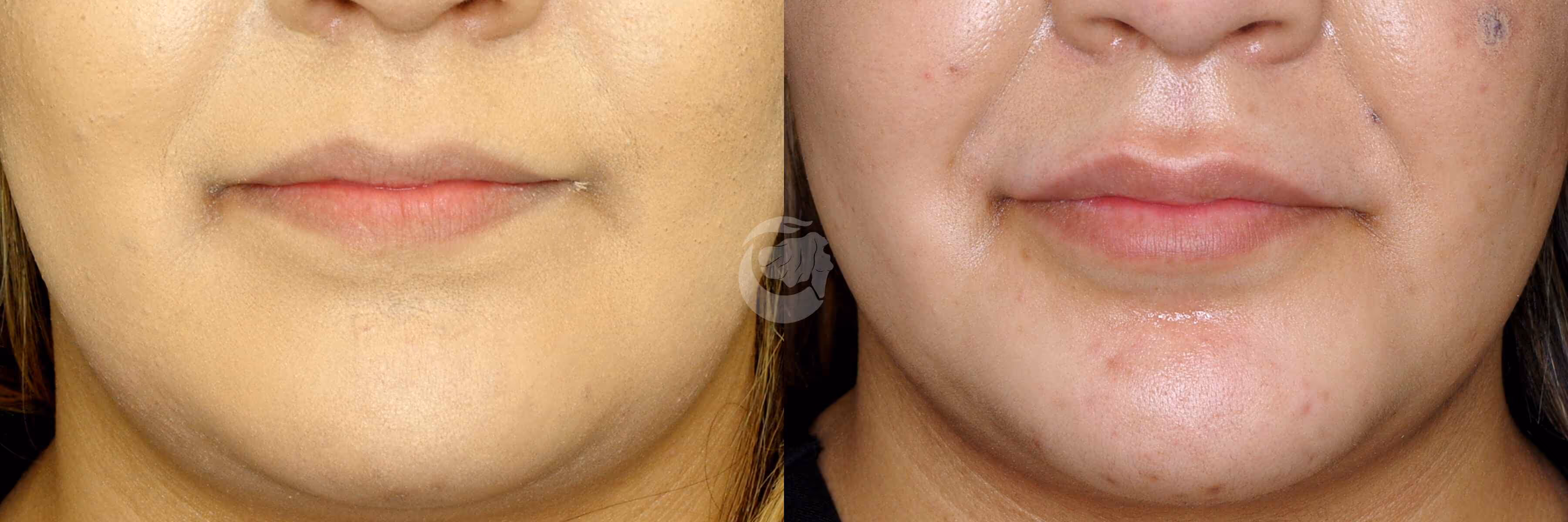 Before And After Patient Image