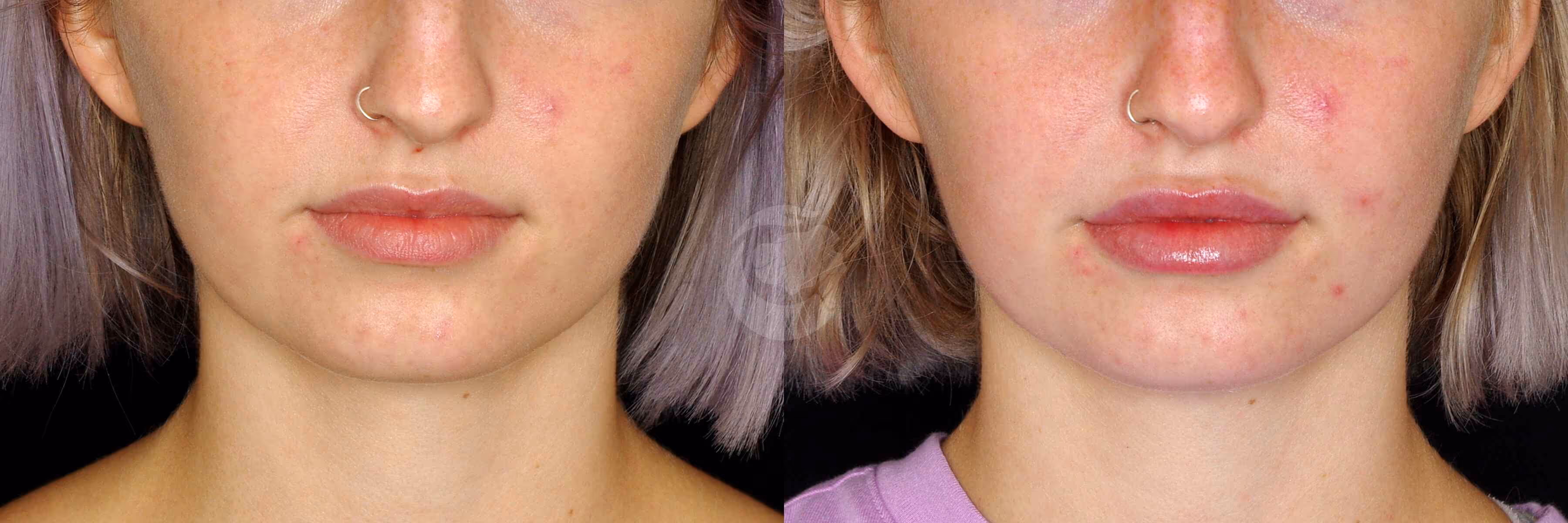 Before And After Patient Image
