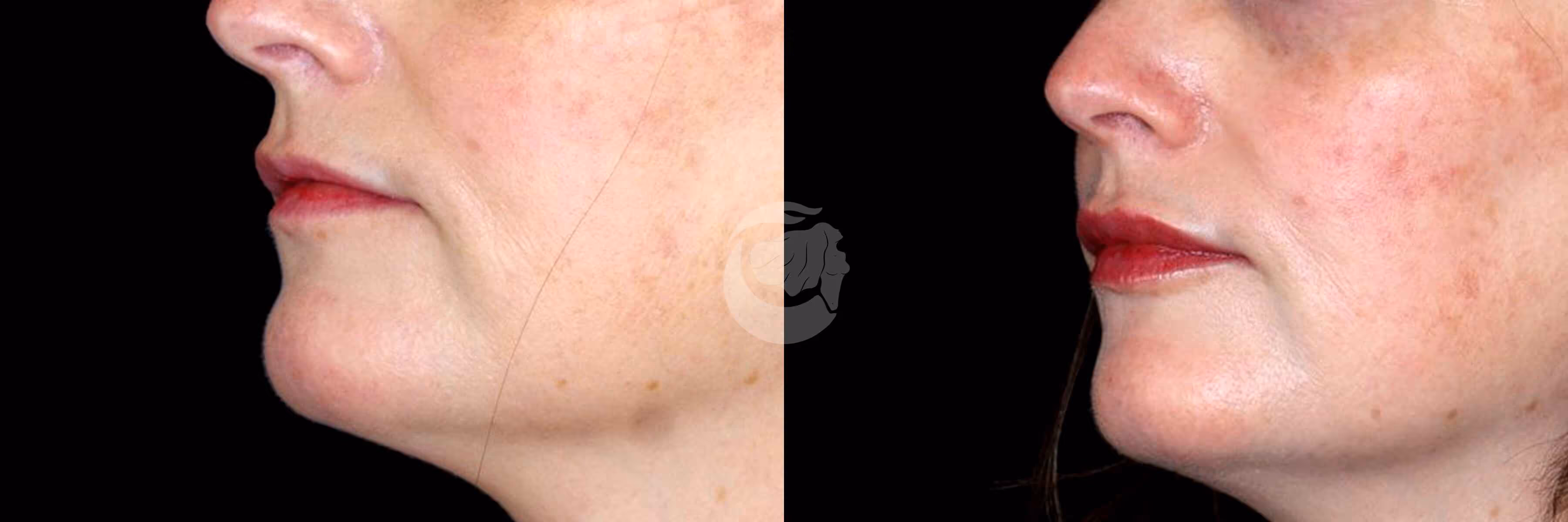 Before And After Patient Image