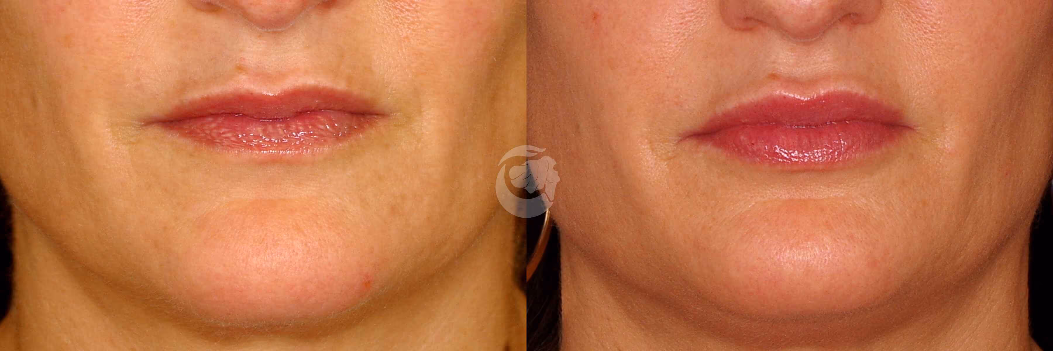 Before And After Patient Image