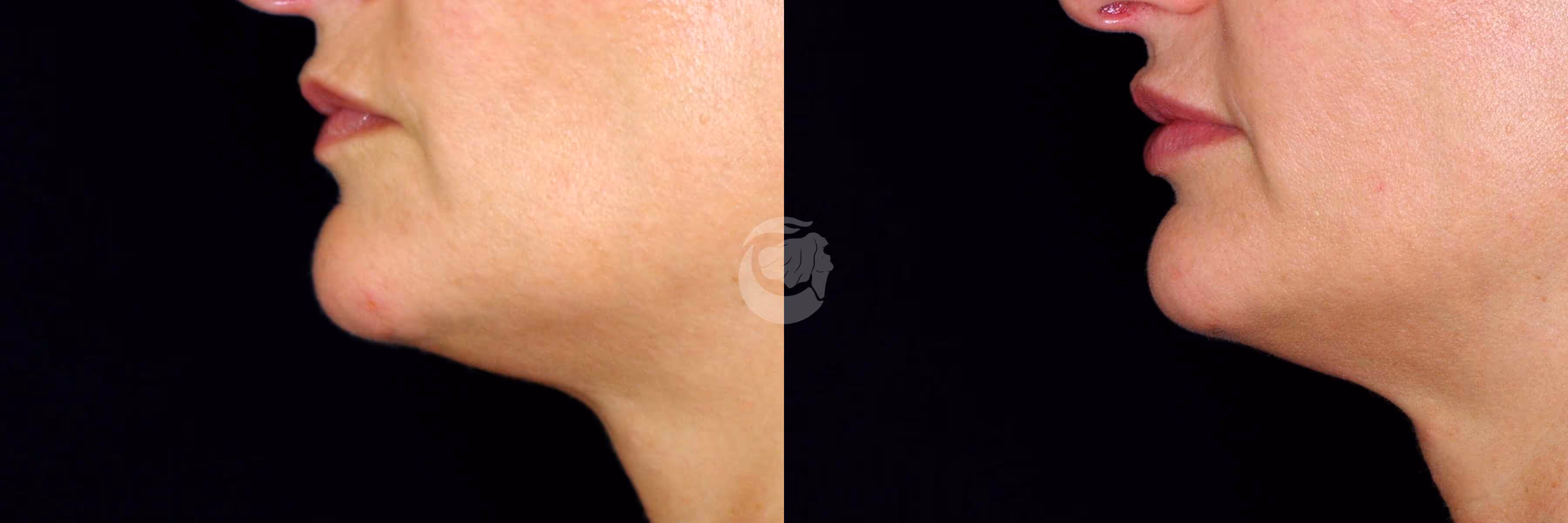 Before And After Patient Image