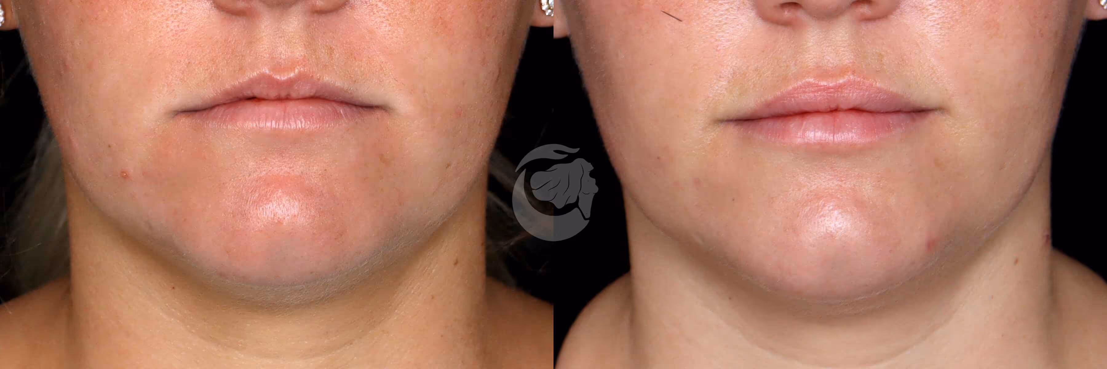 Before And After Patient Image