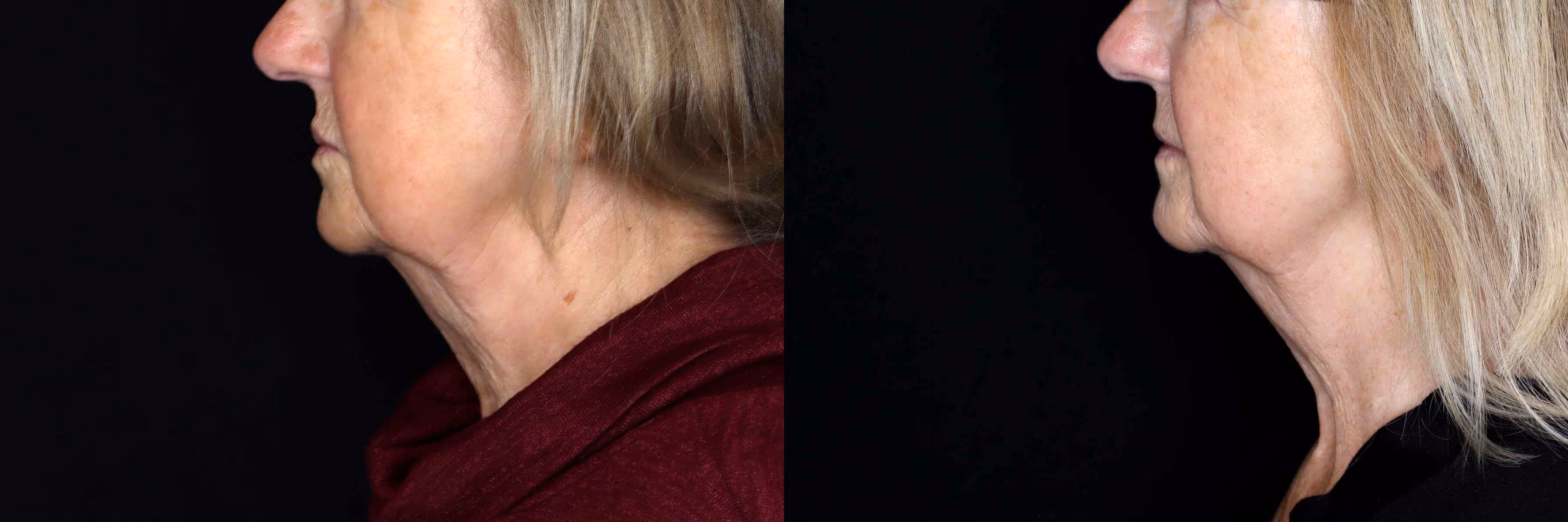Before And After Patient Image