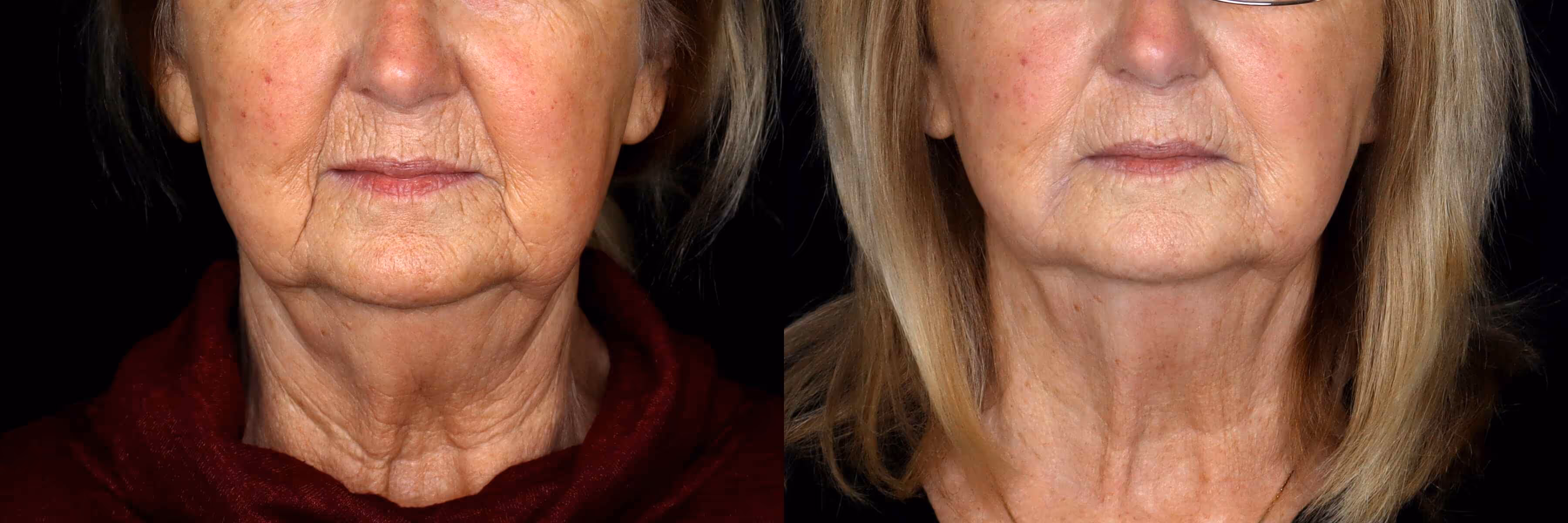 Before And After Patient Image