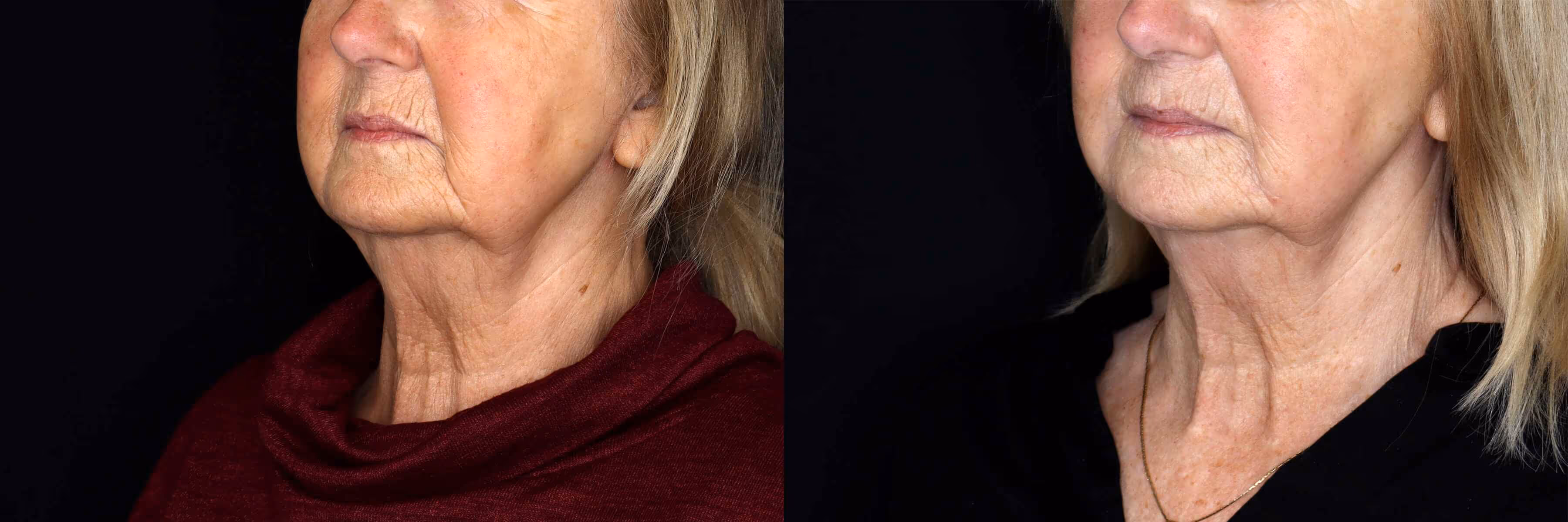 Before And After Patient Image
