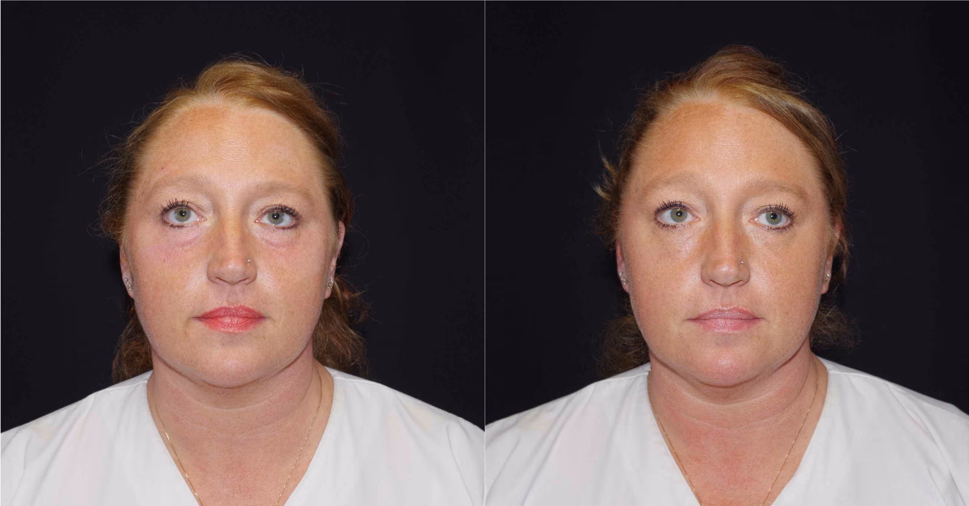 Before And After Patient Image