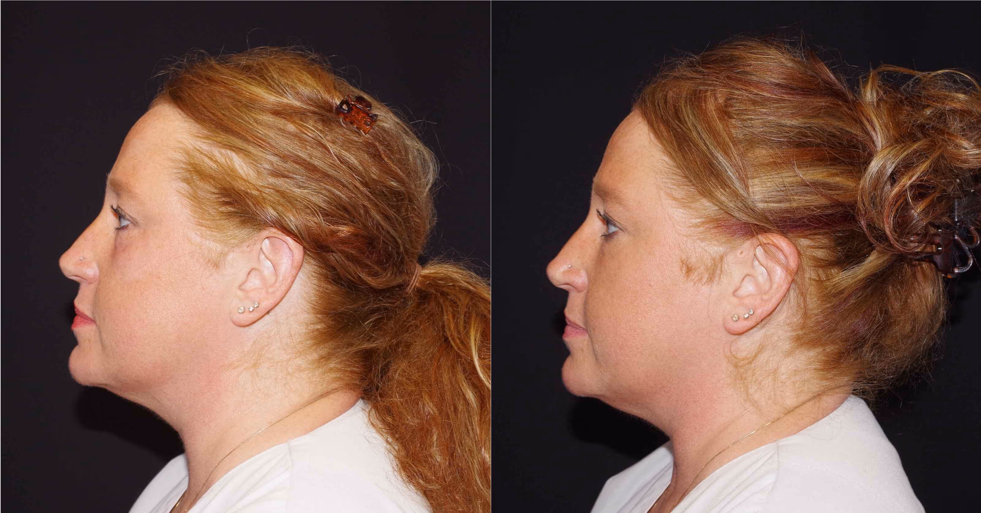 Before And After Patient Image