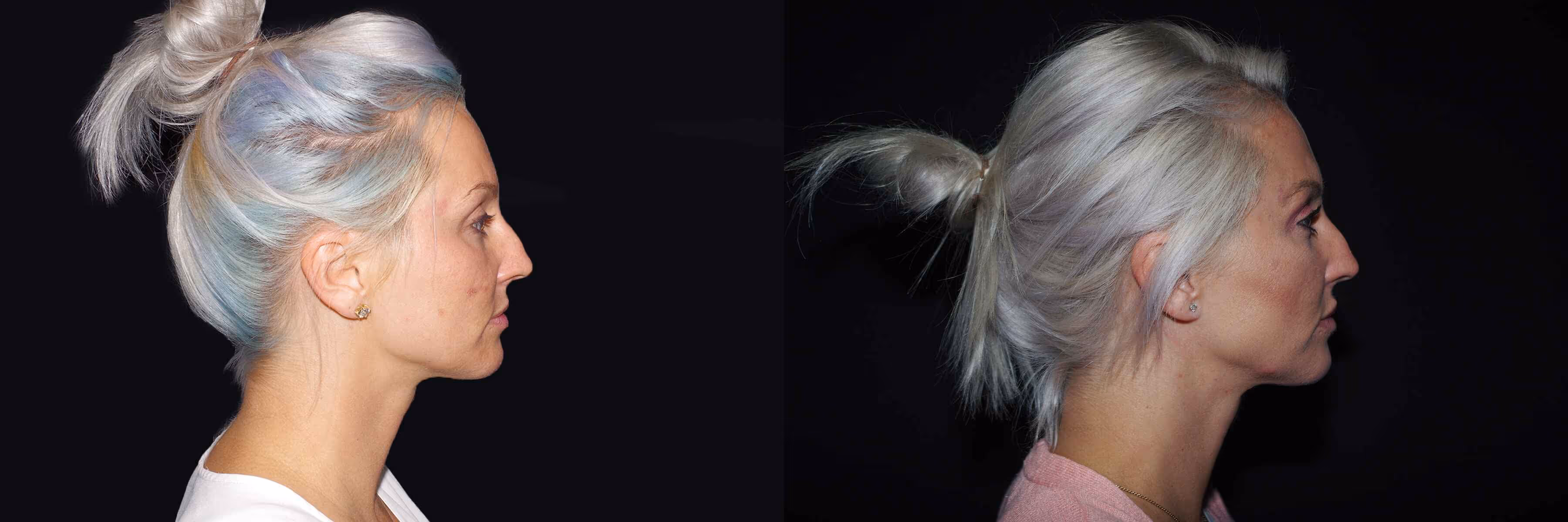 Before And After Patient Image
