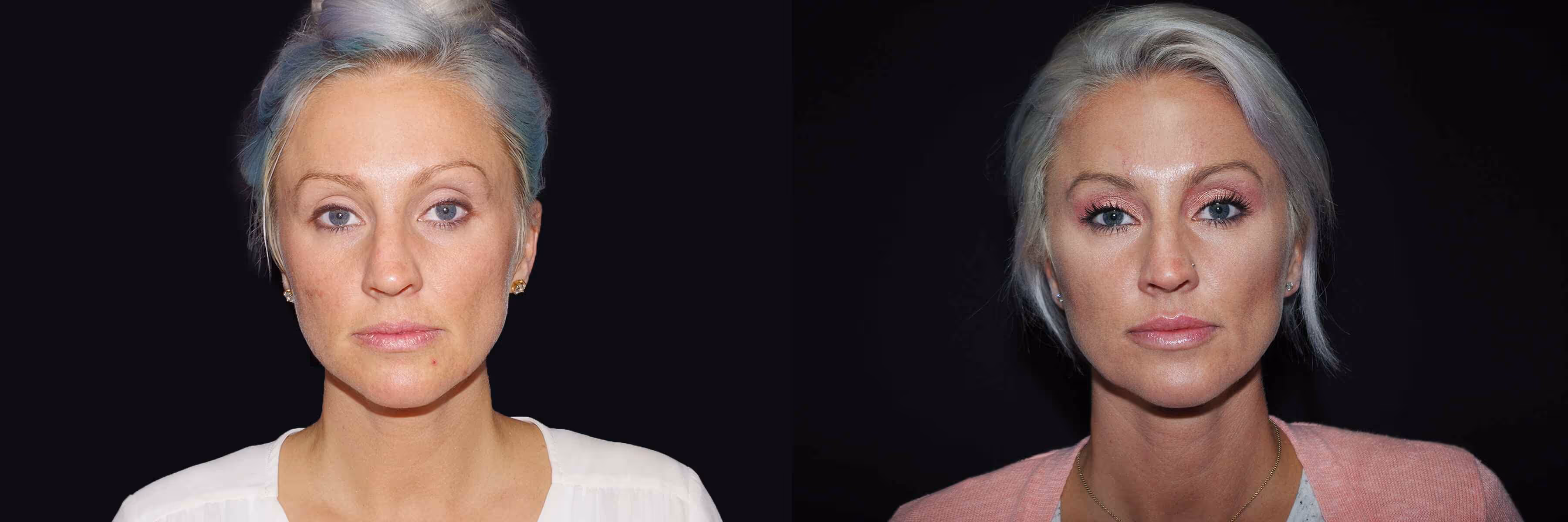 Before And After Patient Image