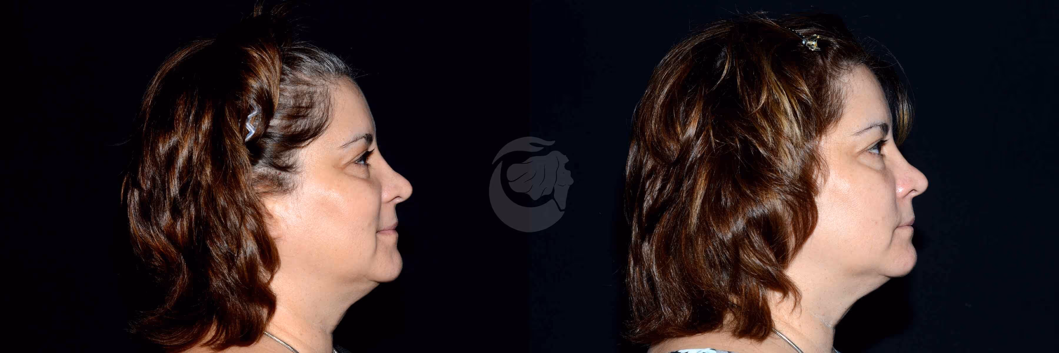 Before And After Patient Image