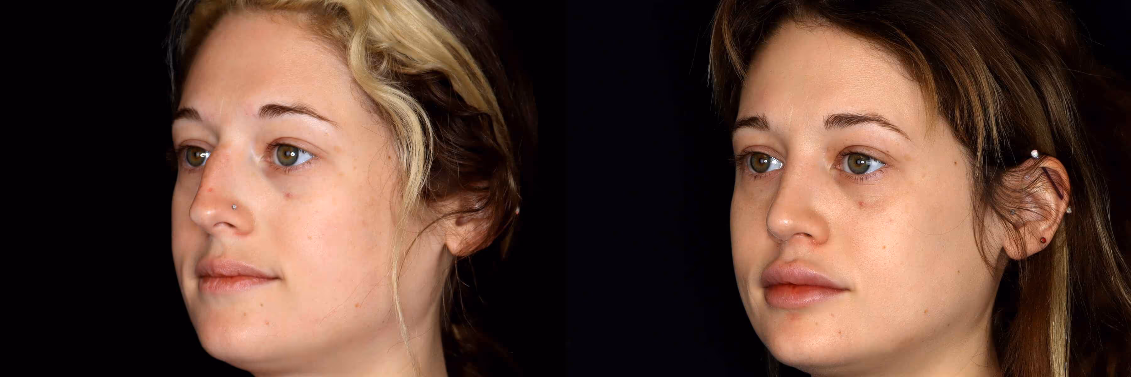 Before And After Patient Image