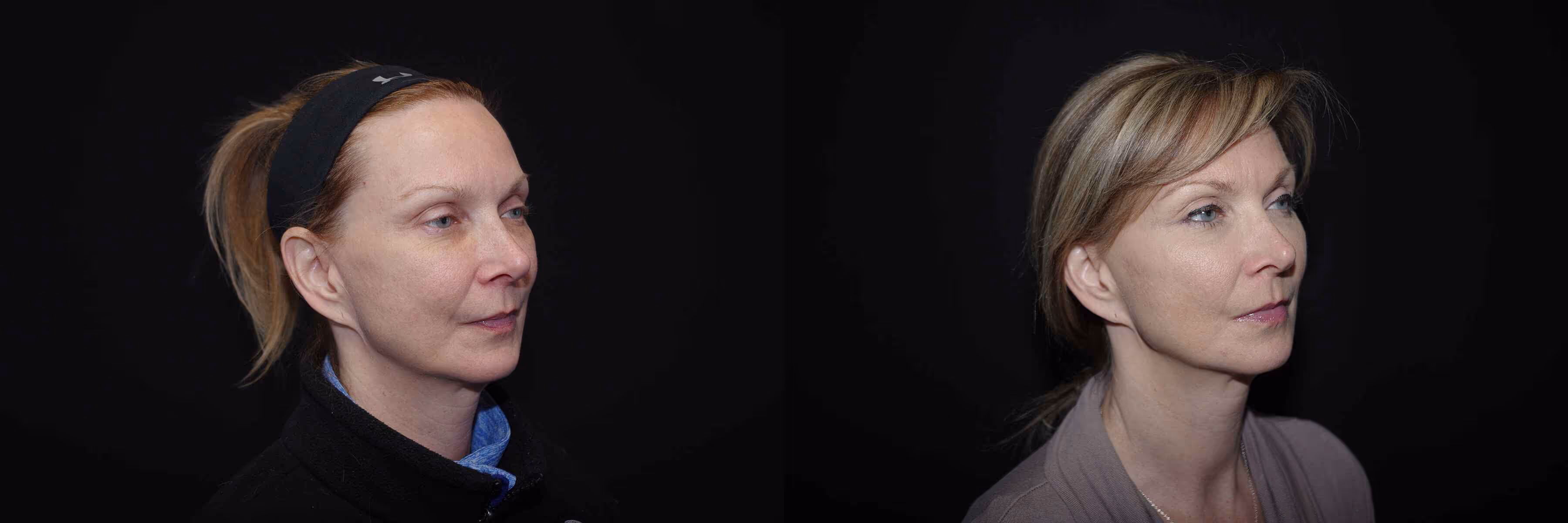 Before And After Patient Image