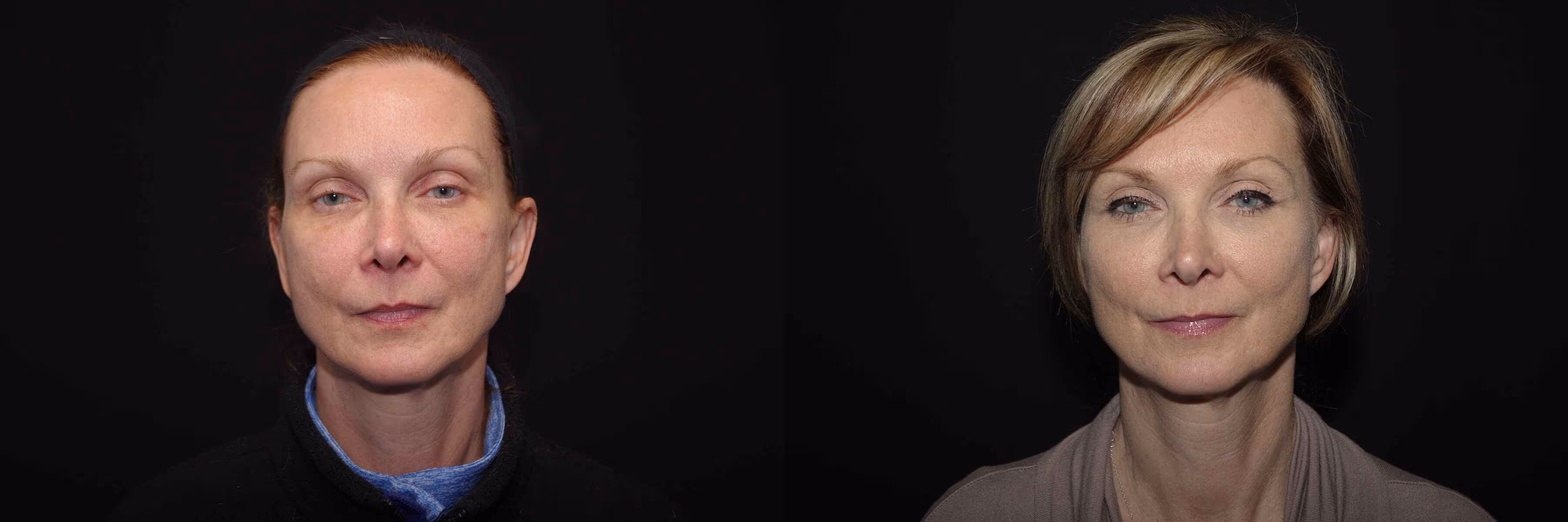Before And After Patient Image