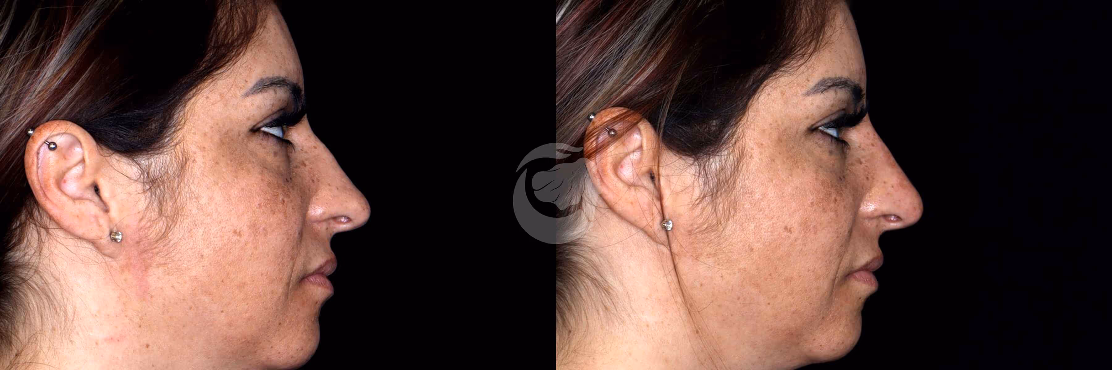 Before And After Patient Image