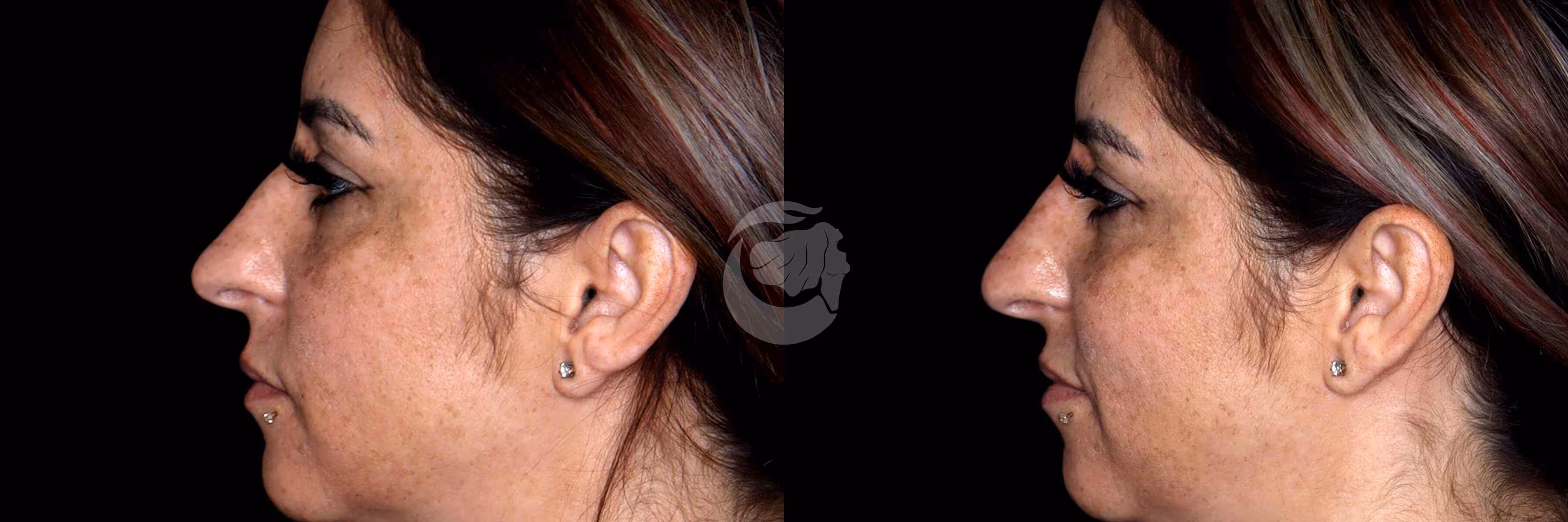 Before And After Patient Image