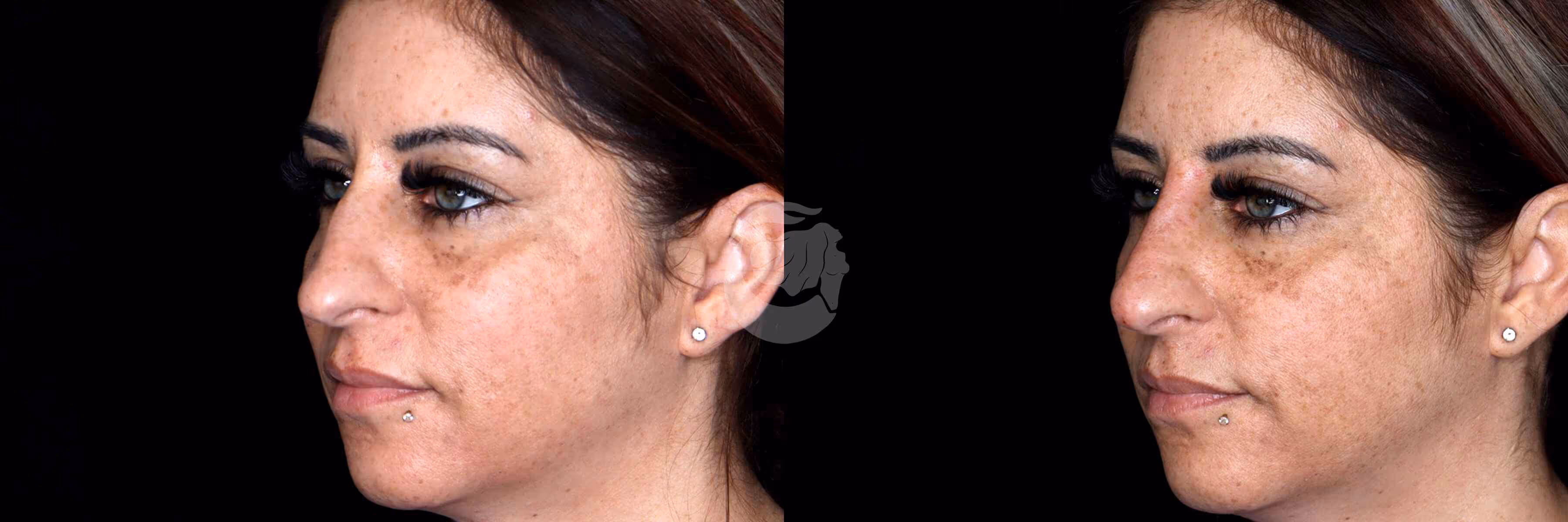 Before And After Patient Image