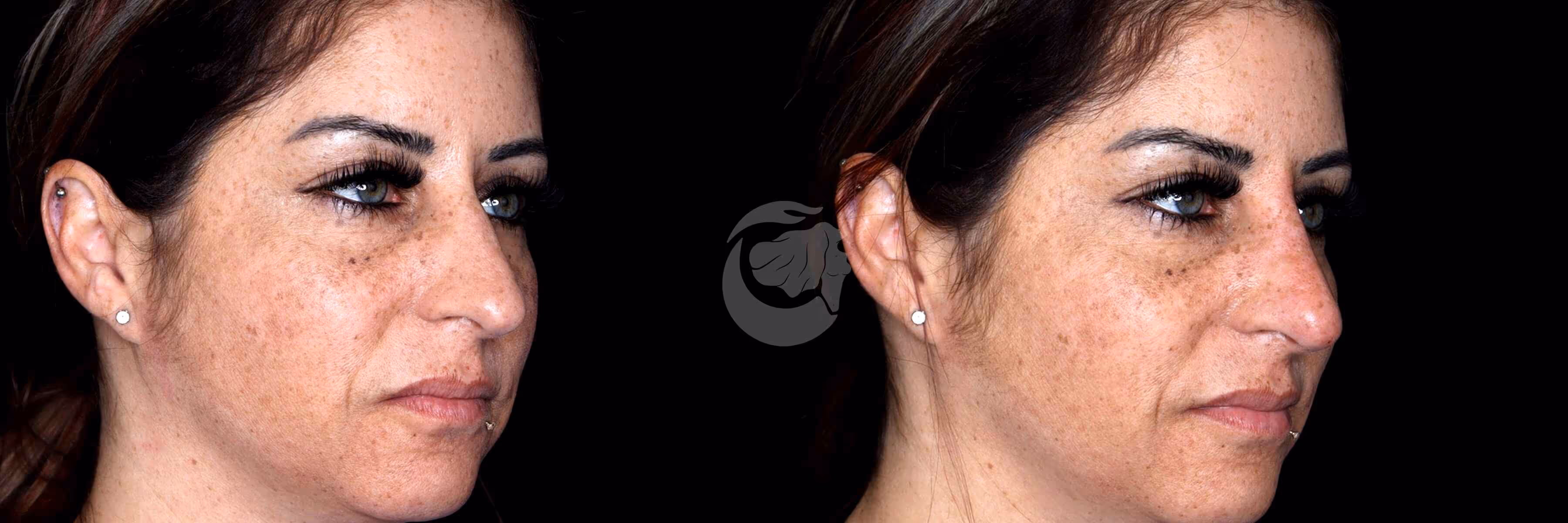 Before And After Patient Image