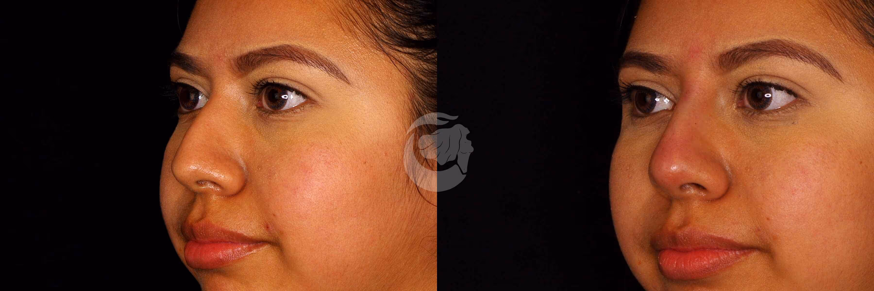 Before And After Patient Image
