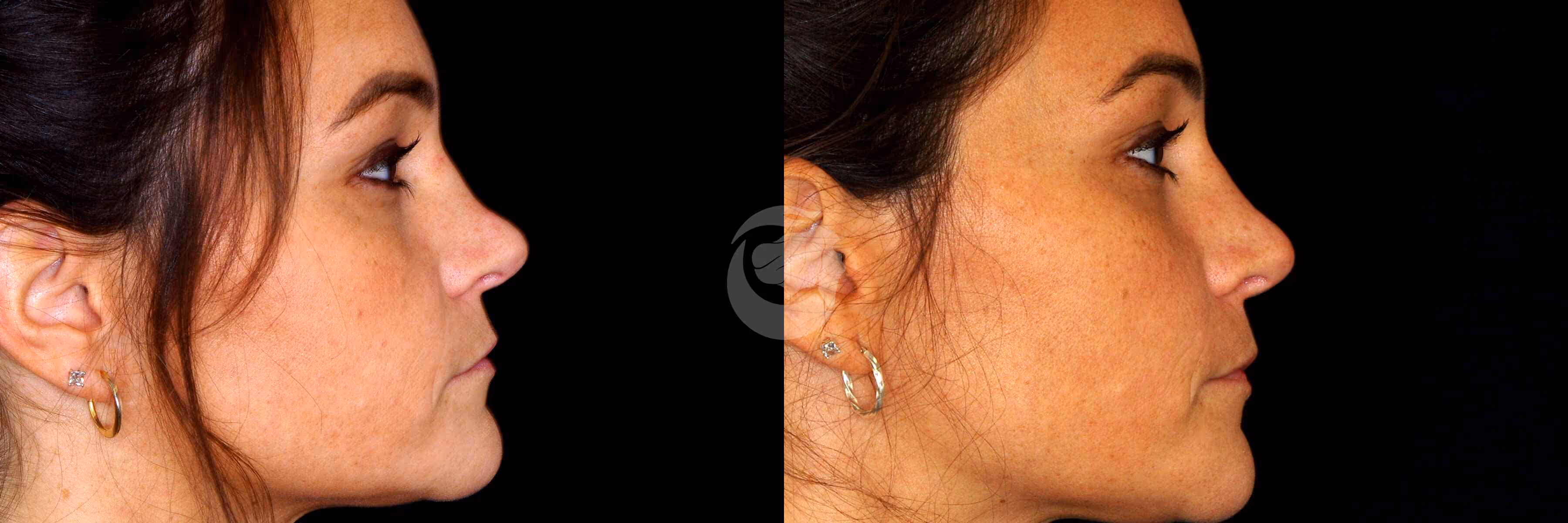Before And After Patient Image