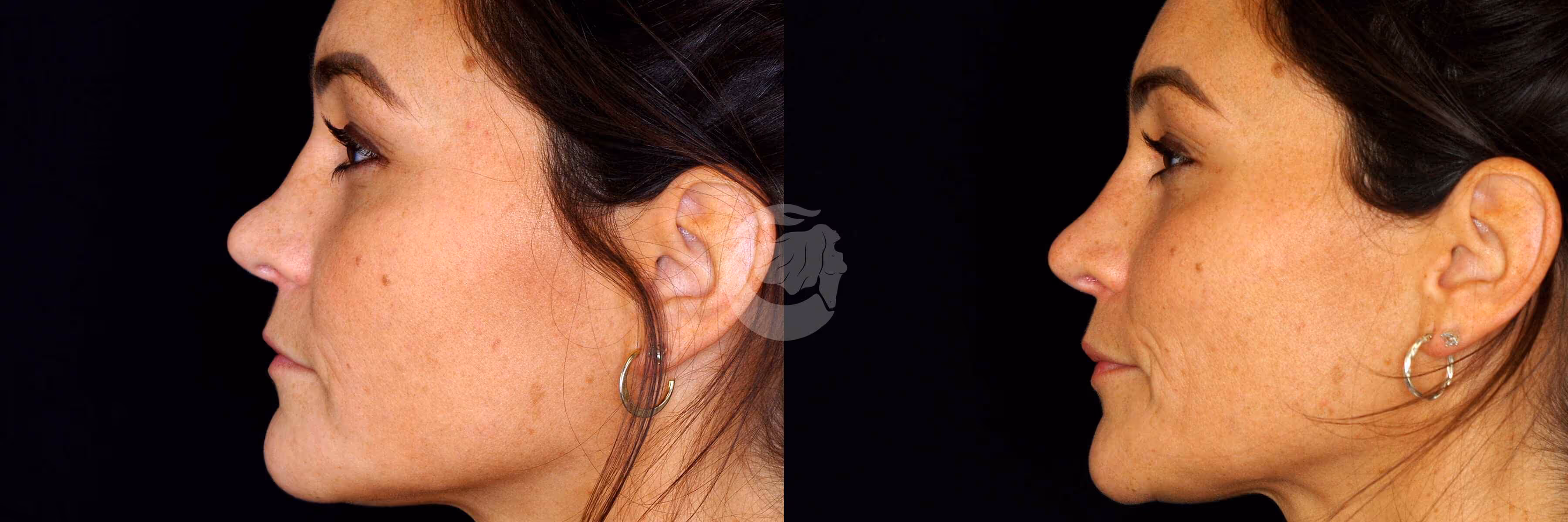 Before And After Patient Image