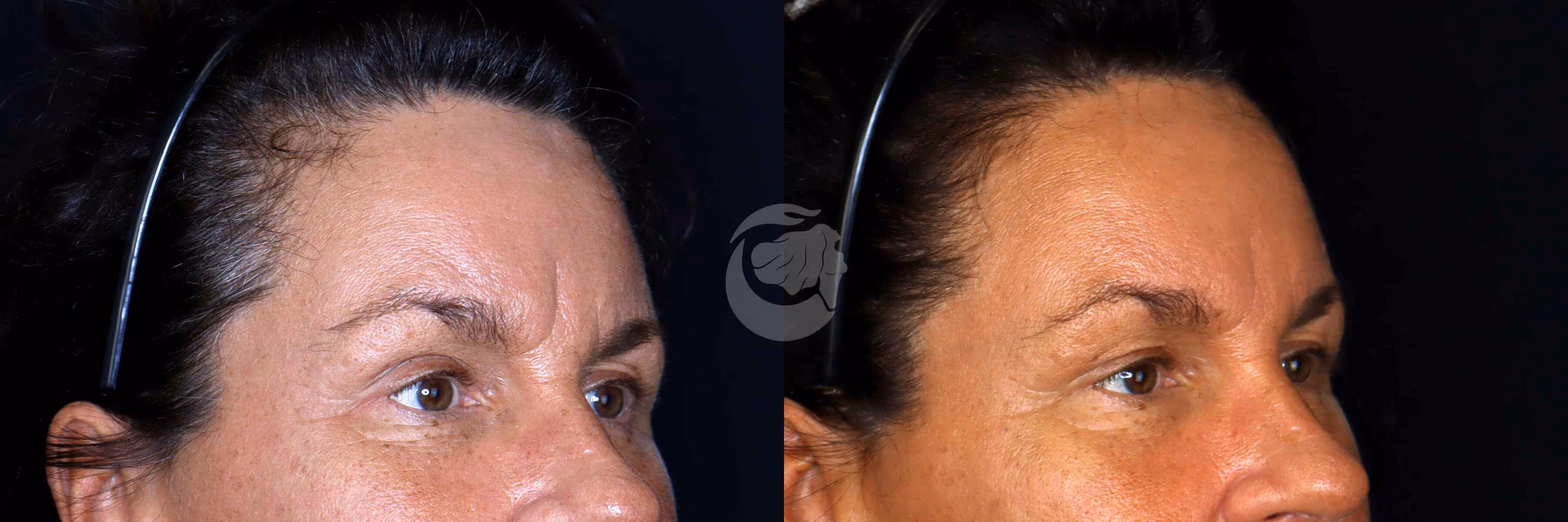 Before And After Patient Image