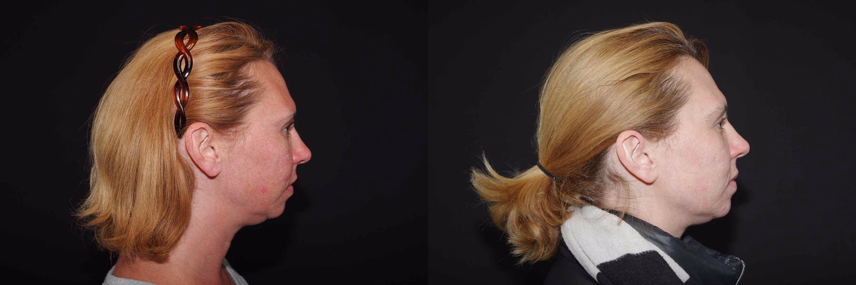 Before And After Patient Image