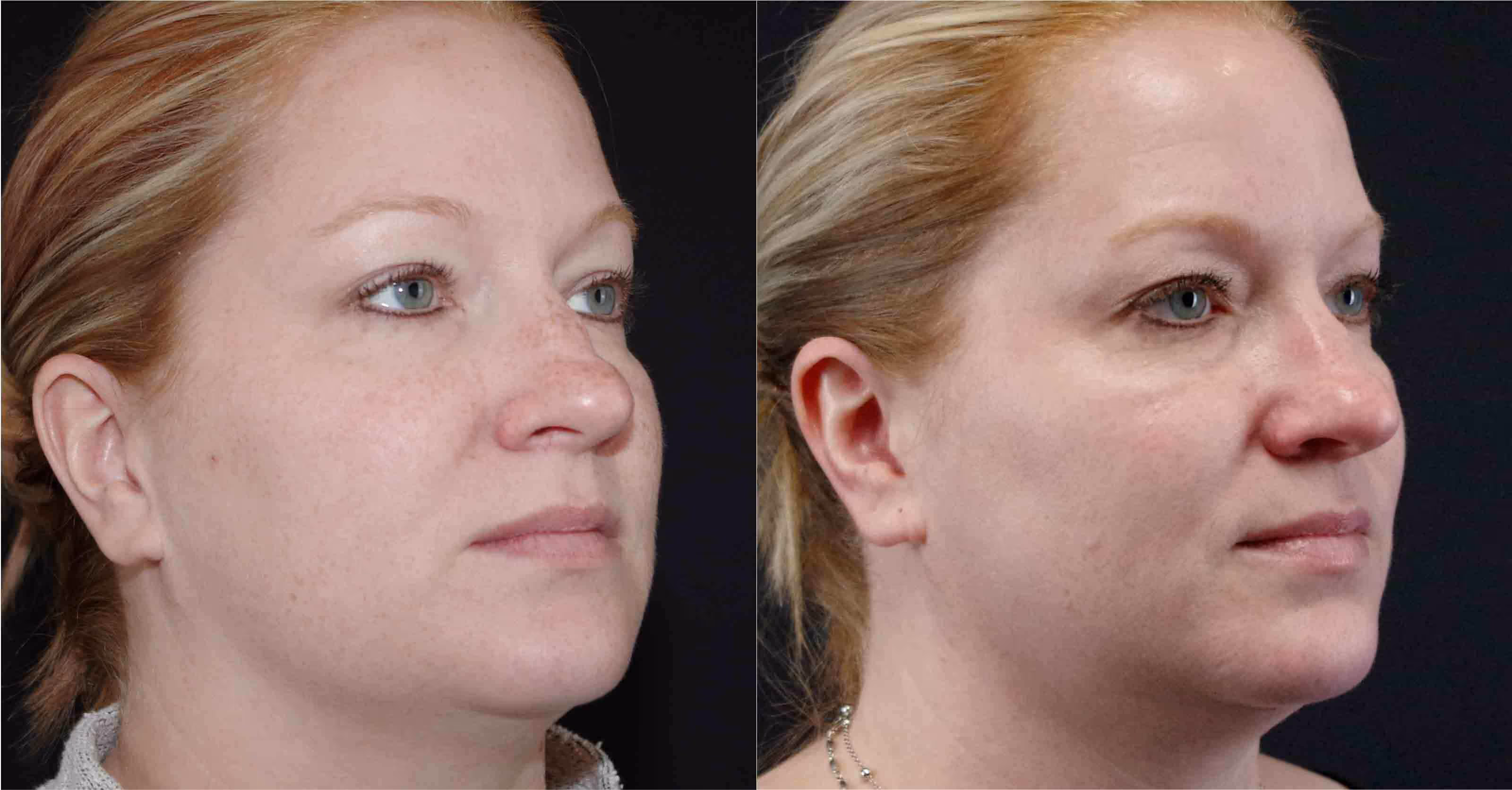 Before And After Patient Image