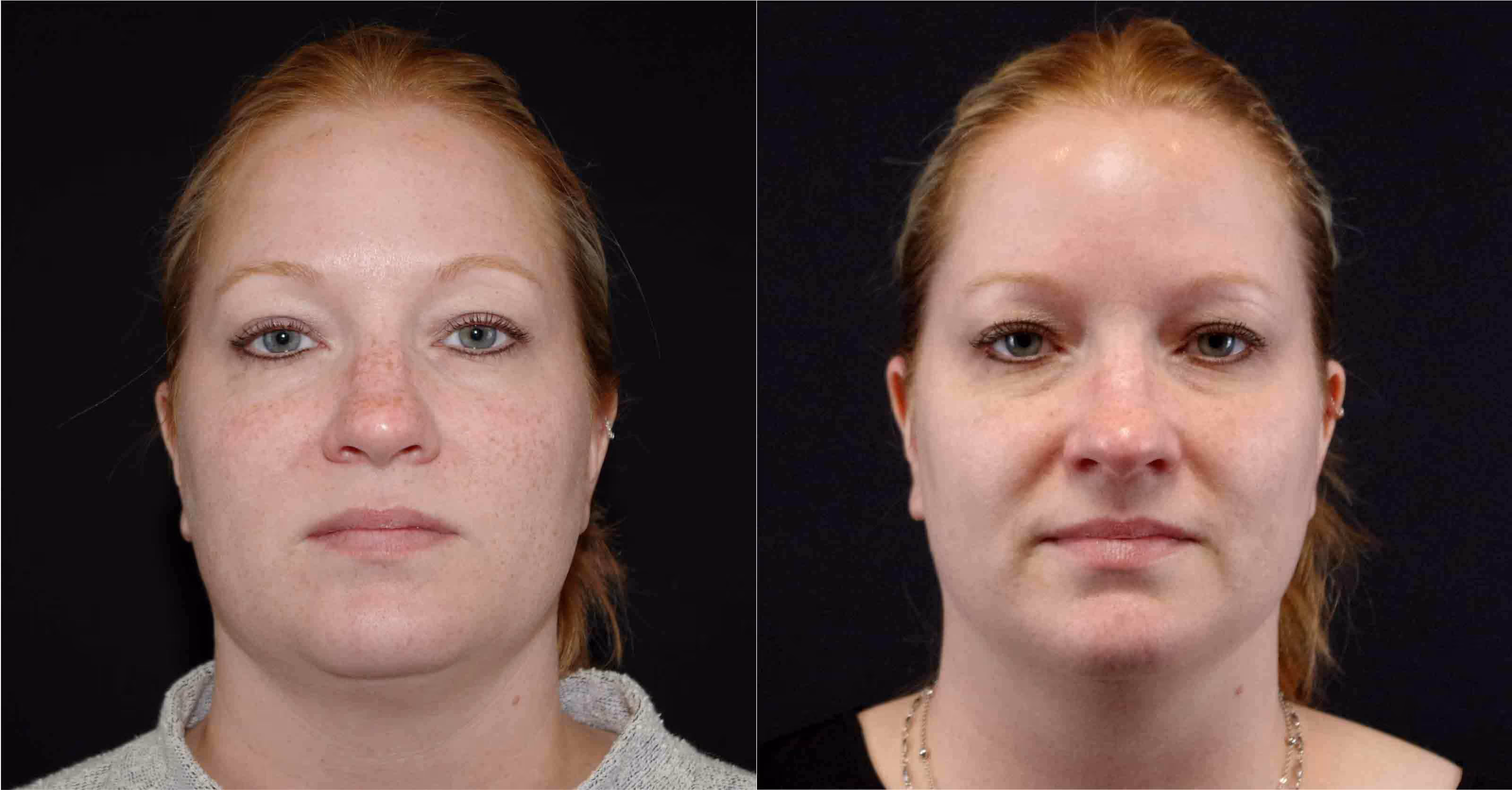 Before And After Patient Image