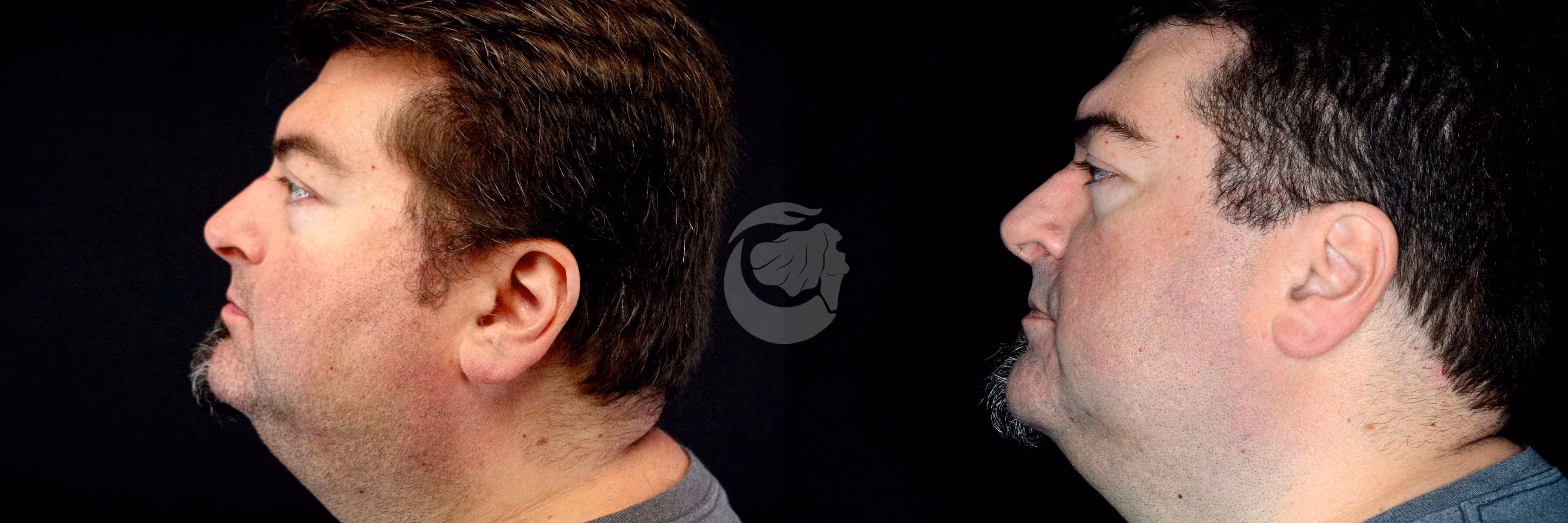 Before And After Patient Image