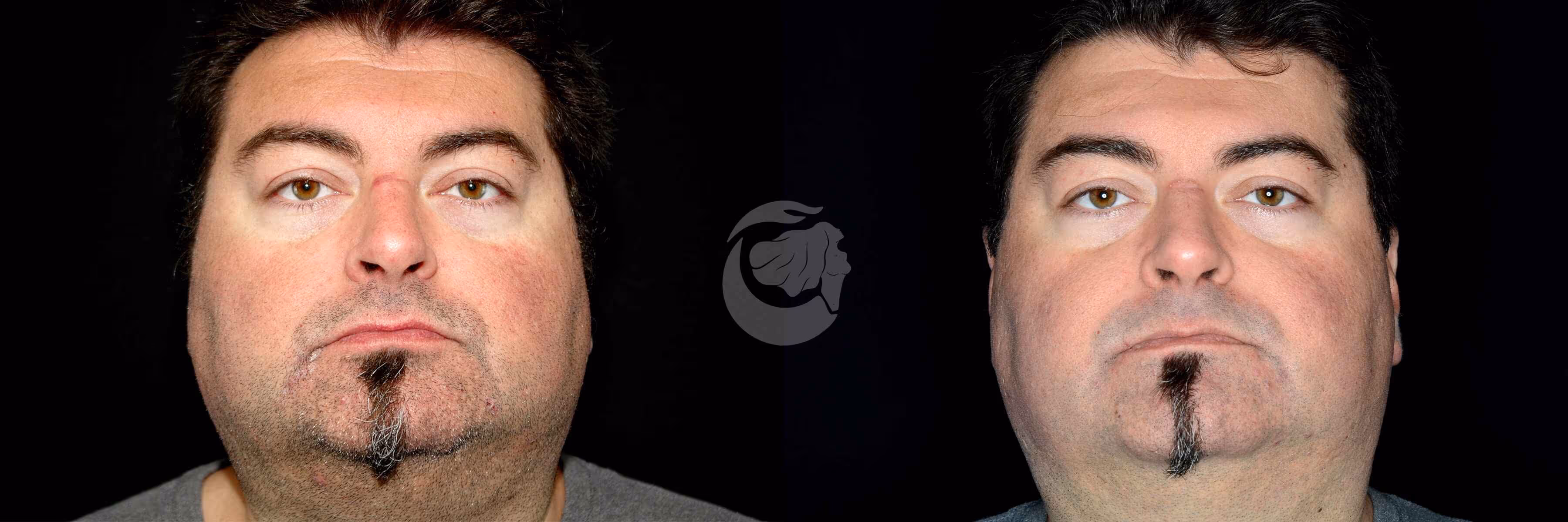 Before And After Patient Image