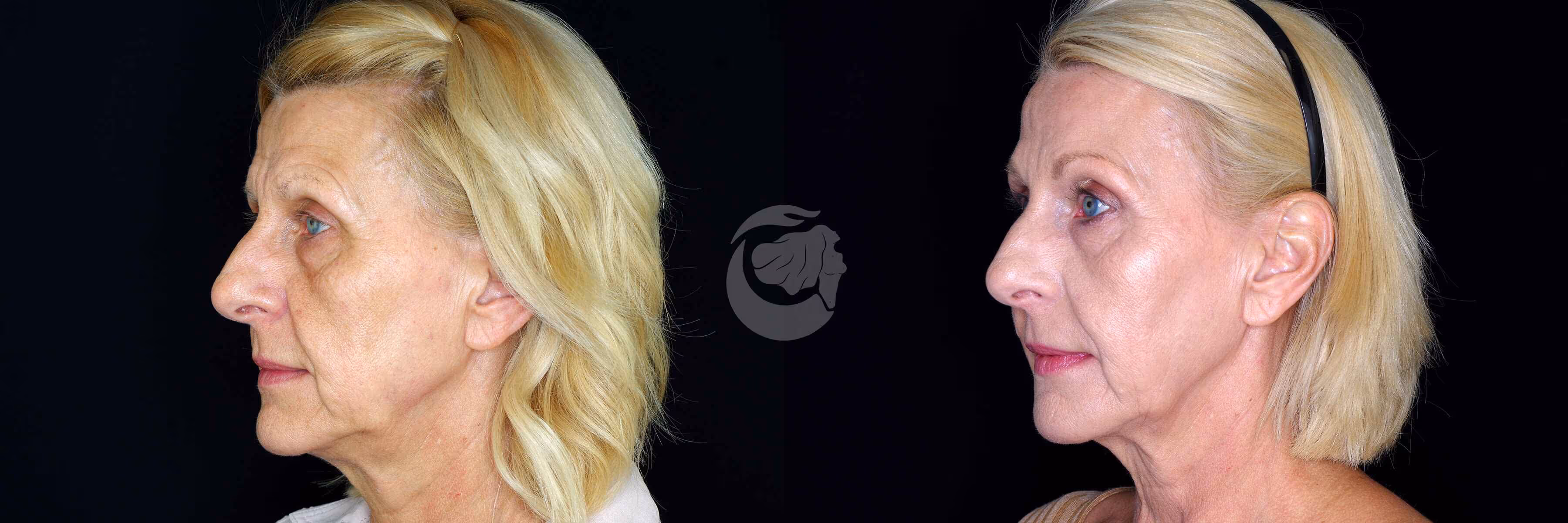Before And After Patient Image