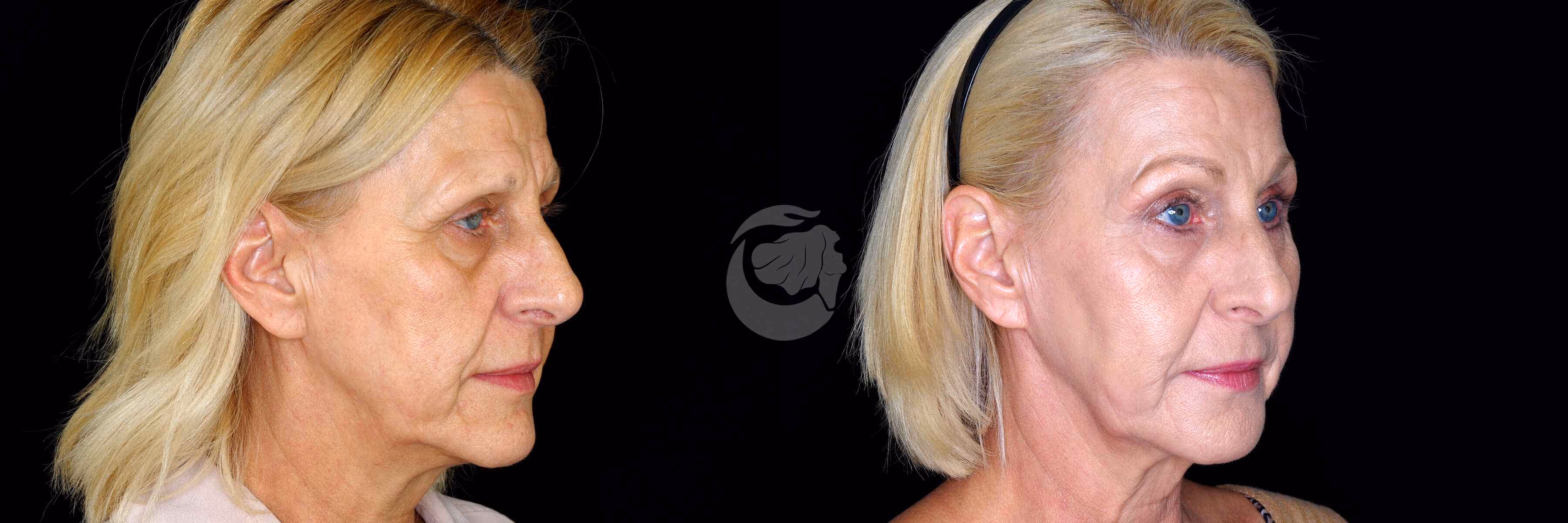 Before And After Patient Image