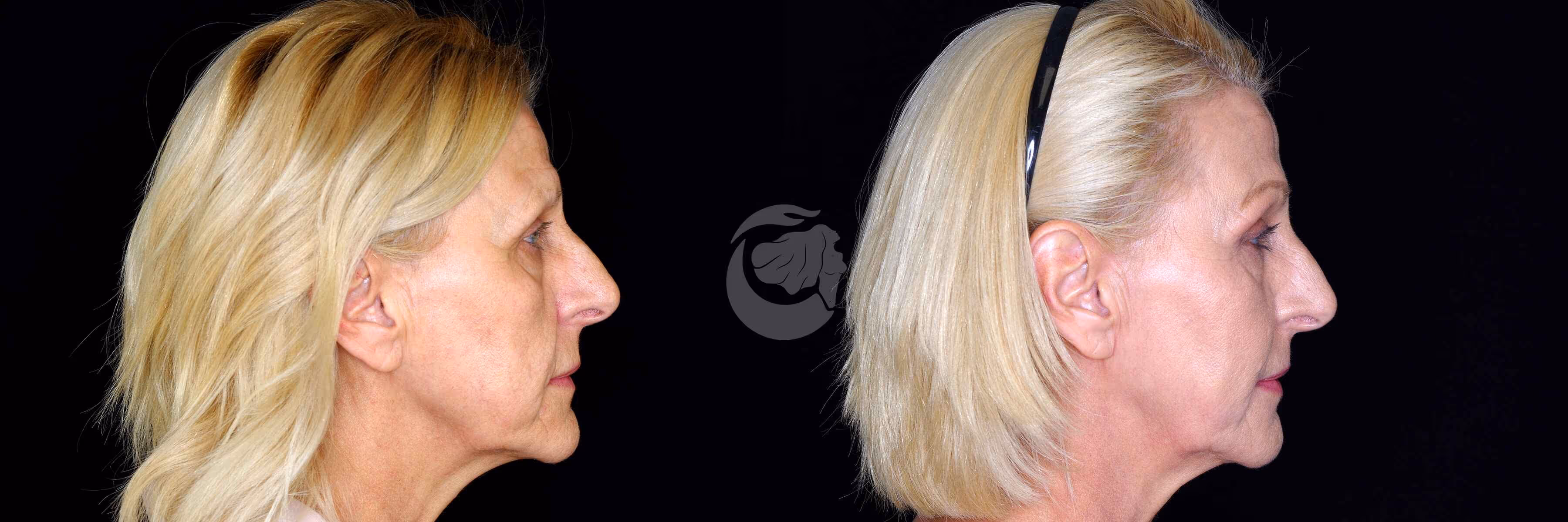 Before And After Patient Image