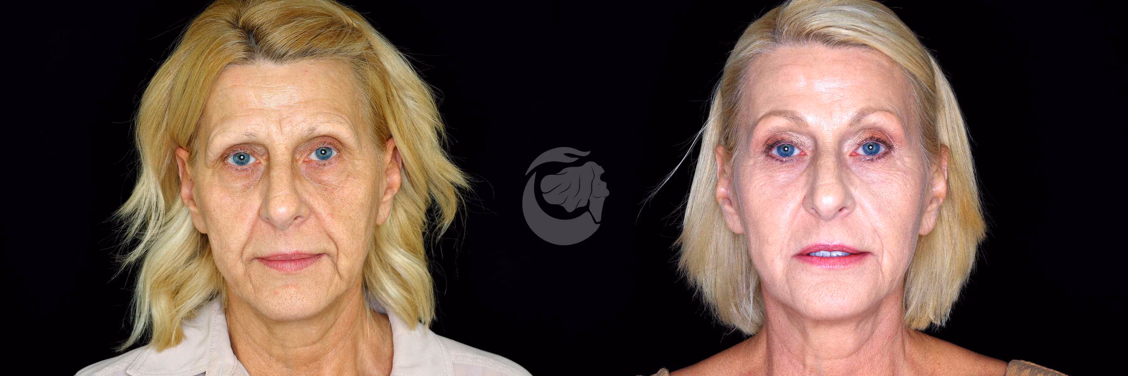 Before And After Patient Image