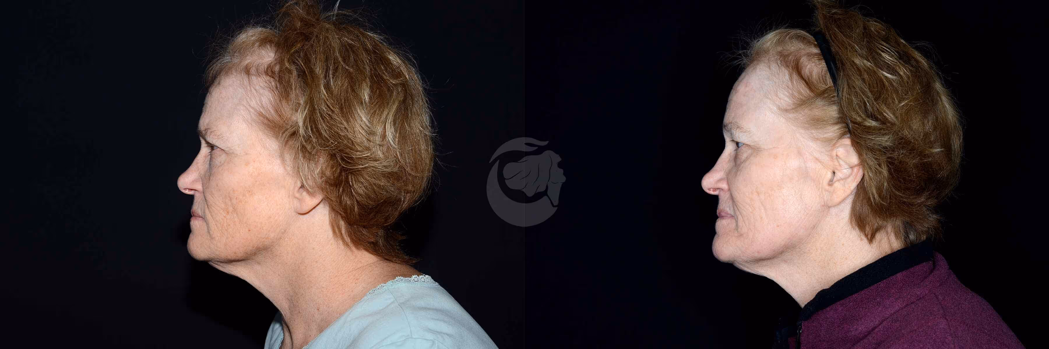 Before And After Patient Image