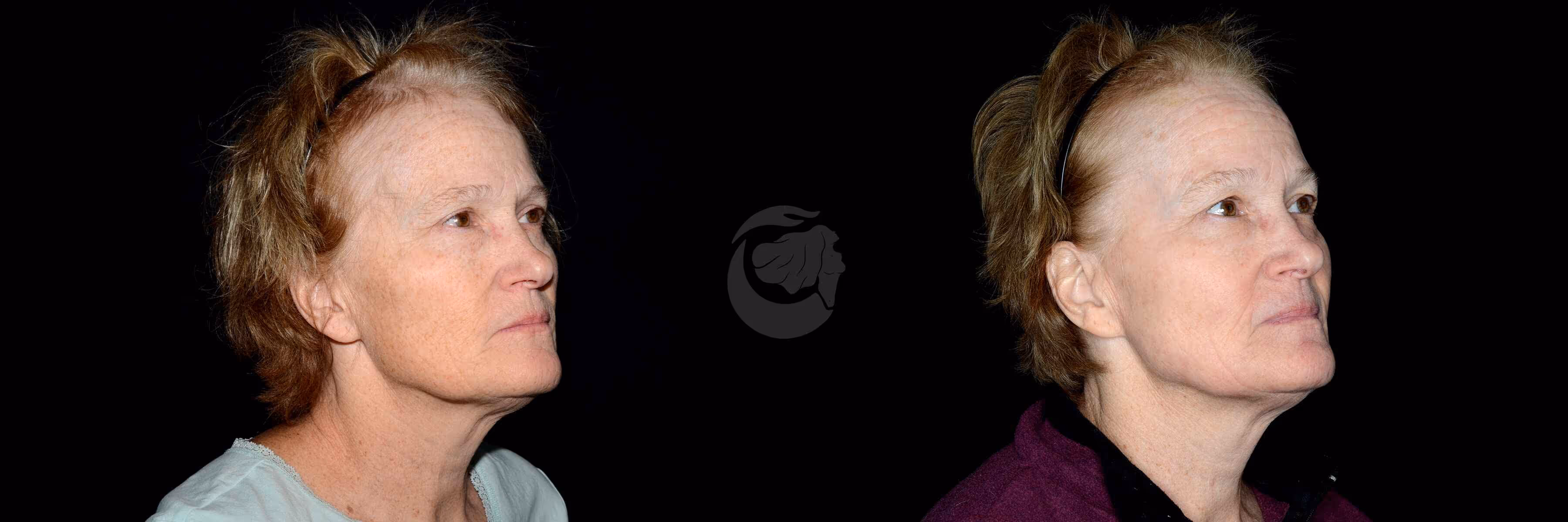 Before And After Patient Image