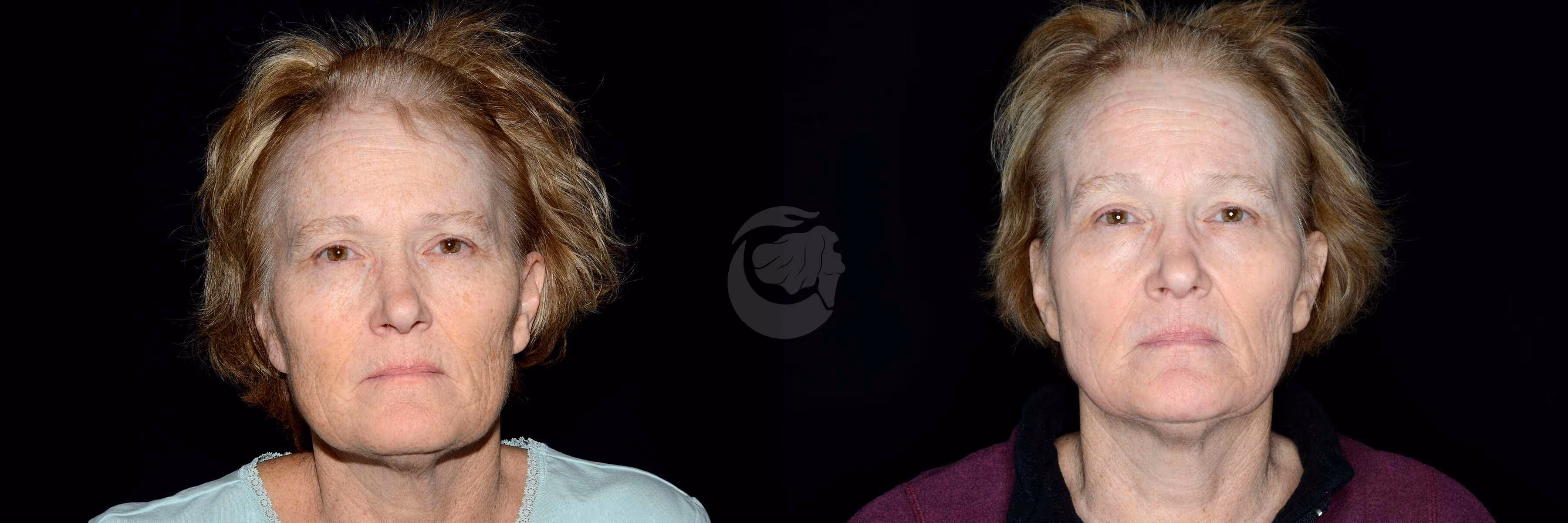 Before And After Patient Image