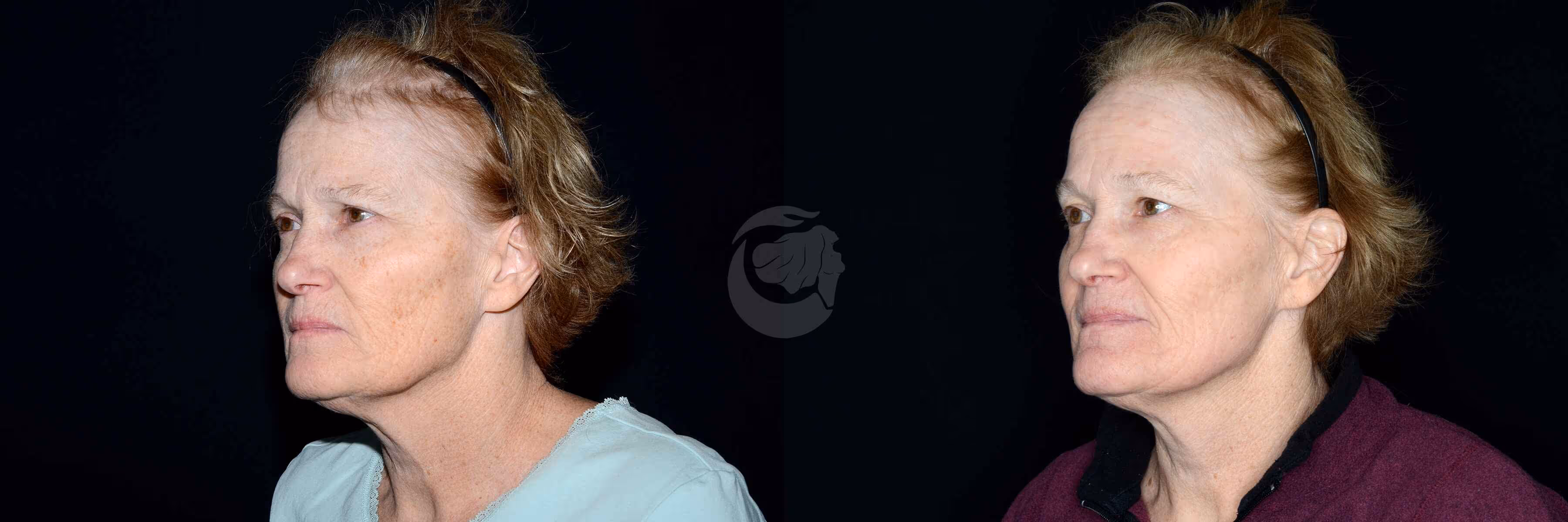 Before And After Patient Image