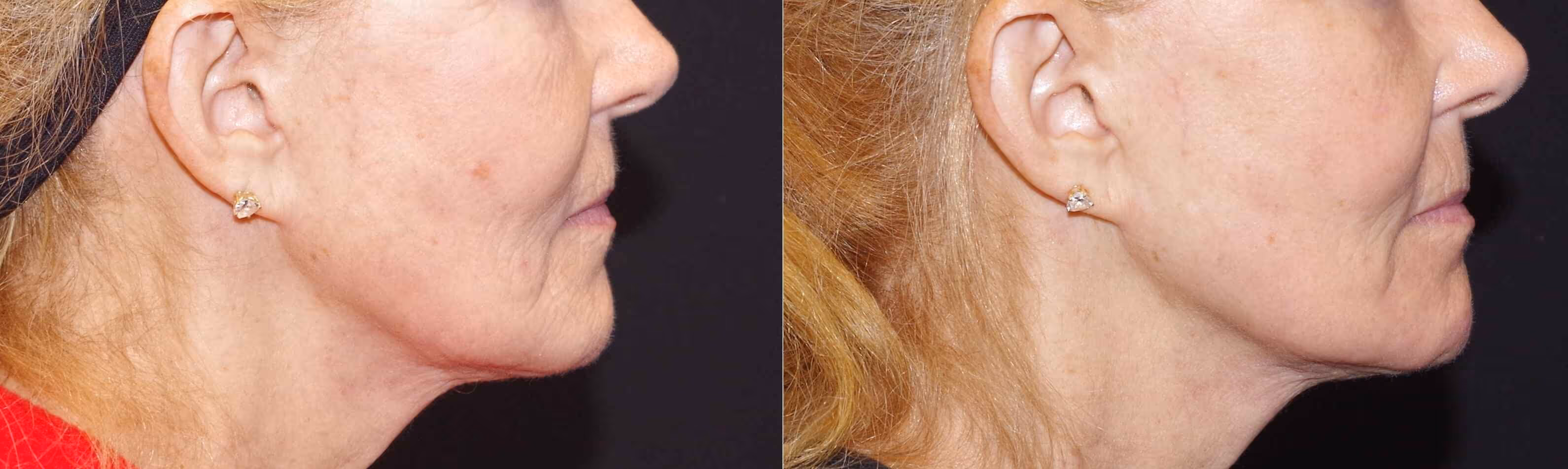 Before And After Patient Image