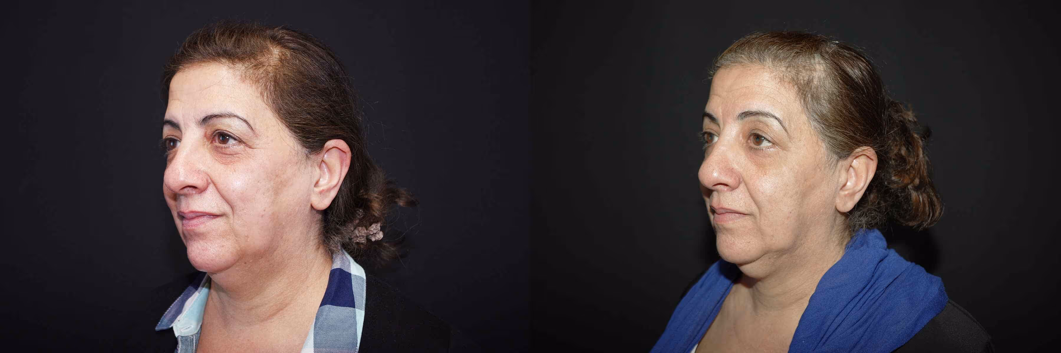 Before And After Patient Image