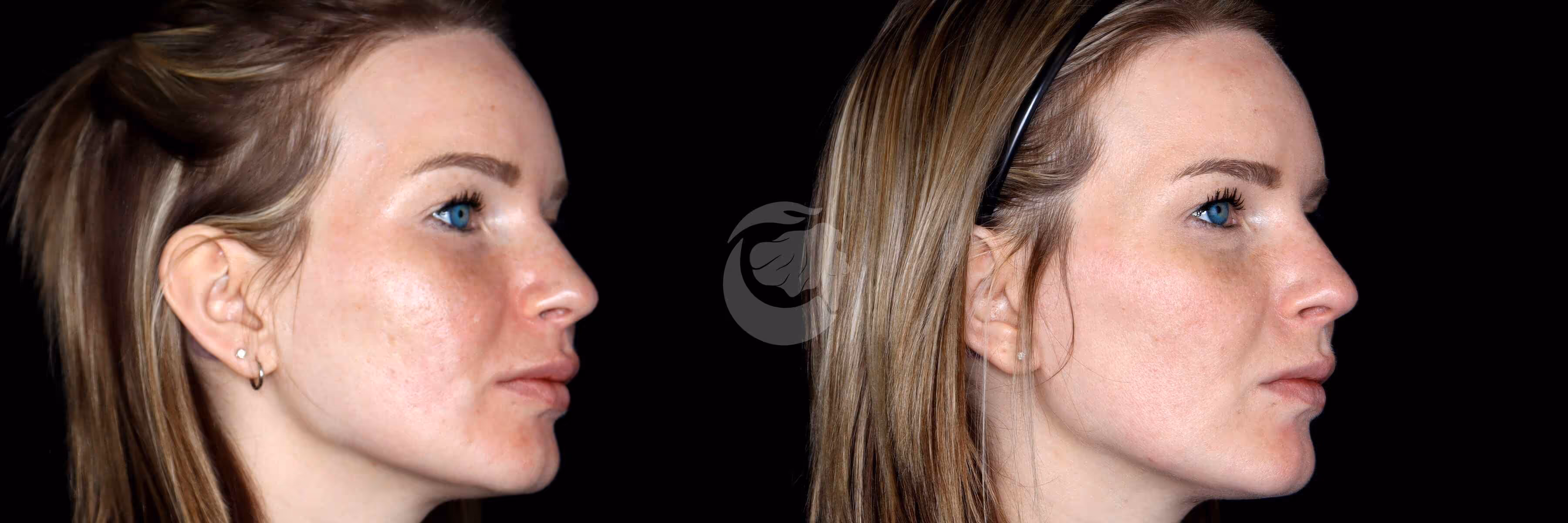 Before And After Patient Image