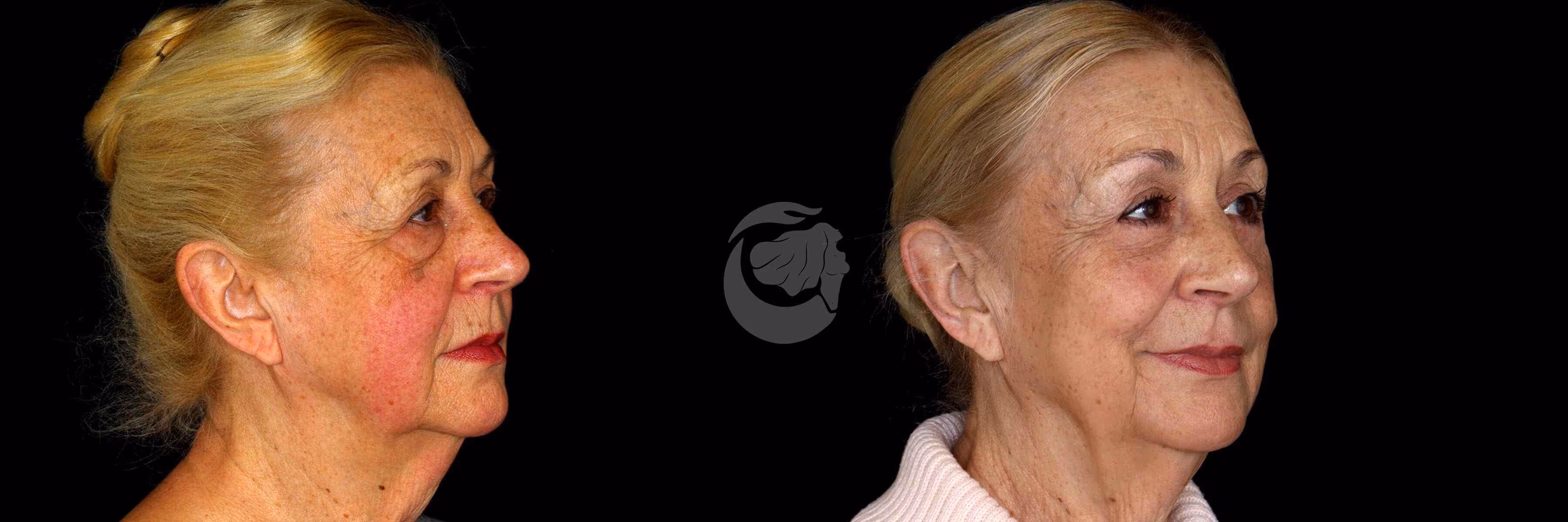 Before And After Patient Image