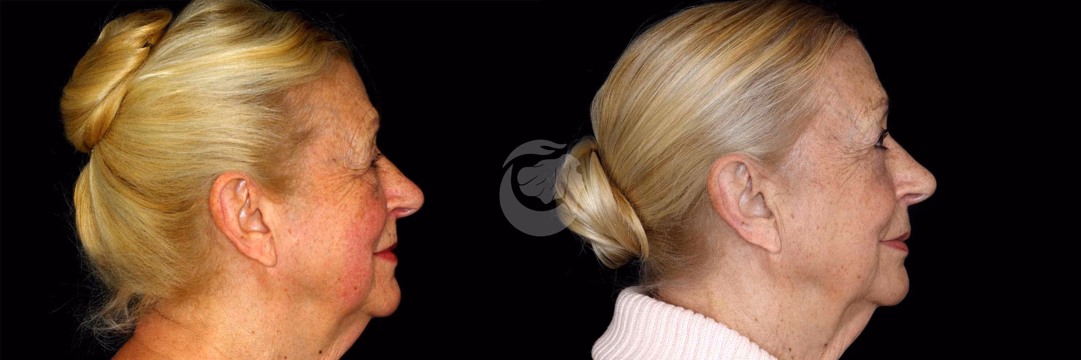 Before And After Patient Image