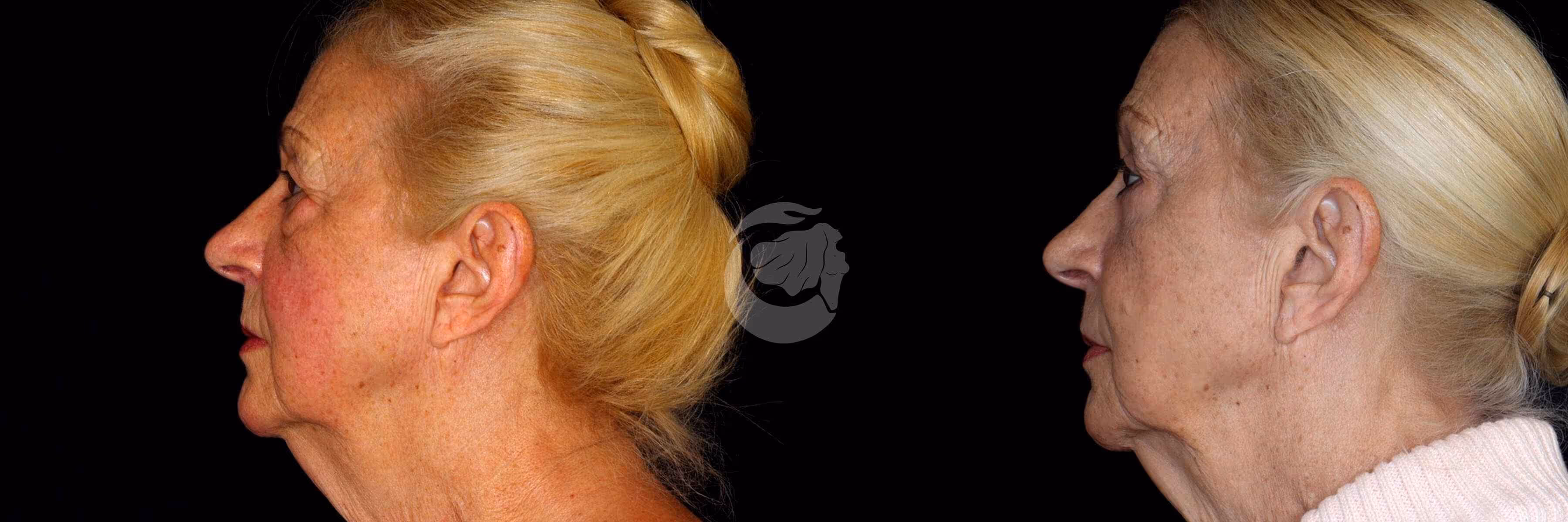 Before And After Patient Image