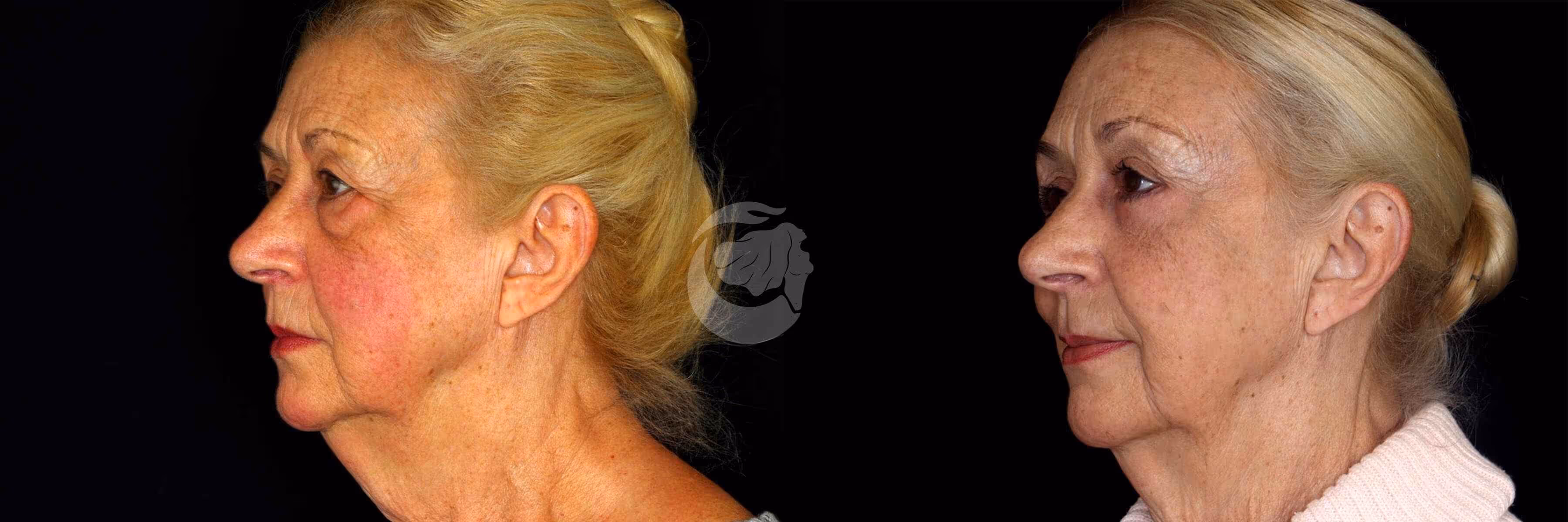 Before And After Patient Image